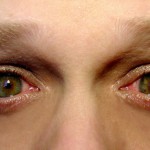 У американки выросли кости в глазах